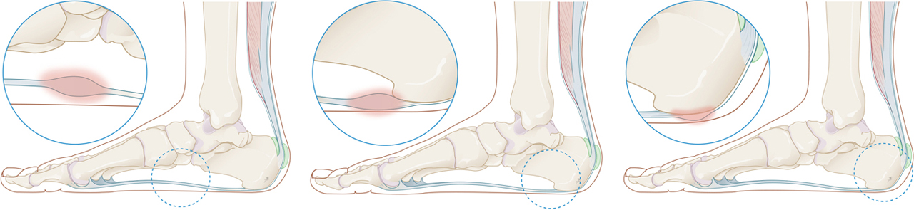Verschillende locaties van een peesplaatontsteking Verschillende locaties van een peesplaatontsteking